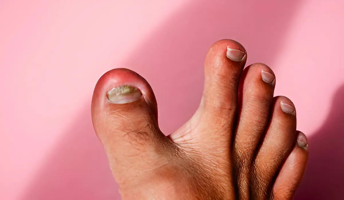 Ingrown Toenail Self-care